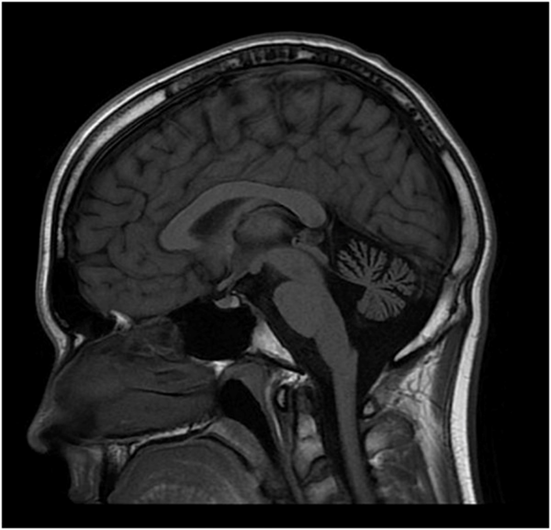 【佳学基因检测】前额高腭弓高囟门增大人中长眼距过宽肌张力减退还有癫痫是不是遗传性DBP缺乏症？